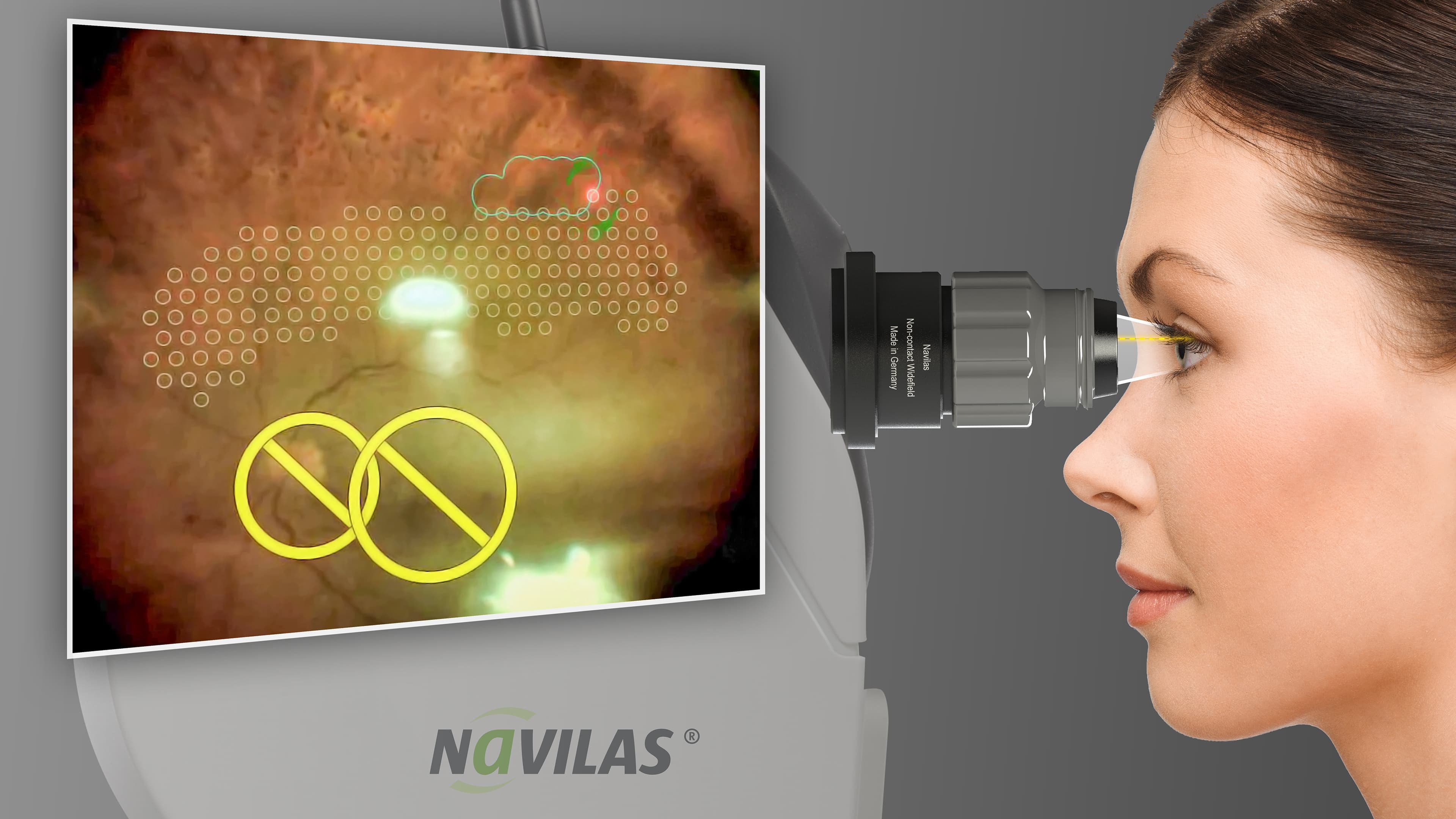 AAO 2018: Non-contact Panretinal Photocoagulation for Navilas® 577s Introduced